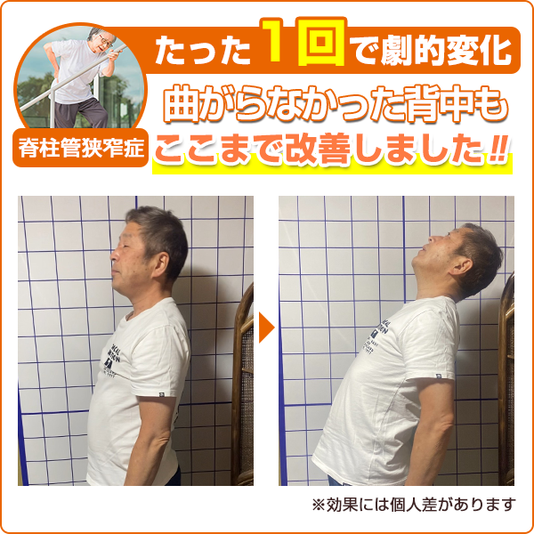 ビフォーアフター：脊柱管狭窄症