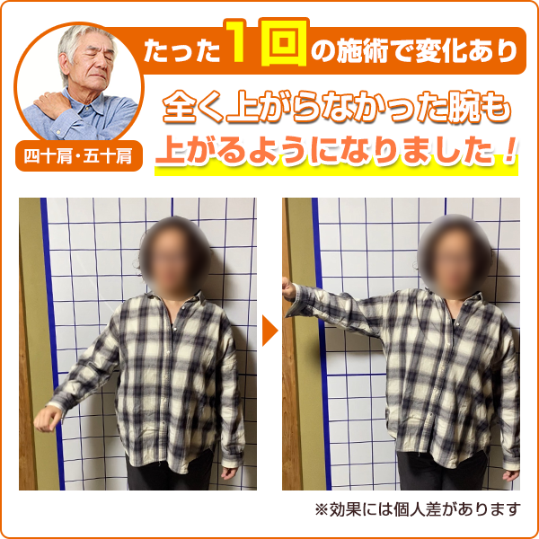 ビフォーアフター：四十肩・五十肩