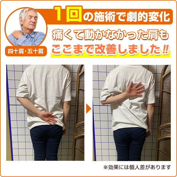 ビフォーアフター：四十肩・五十肩