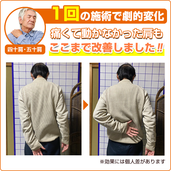 ビフォーアフター：四十肩・五十肩