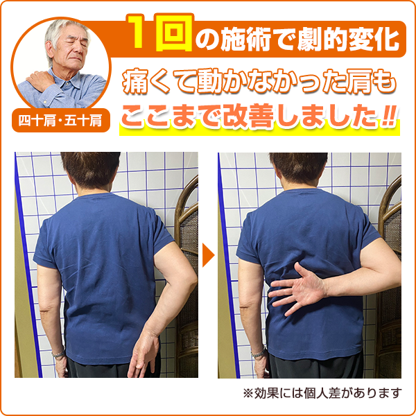 ビフォーアフター：四十肩・五十肩