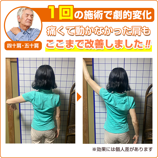 ビフォーアフター：四十肩・五十肩
